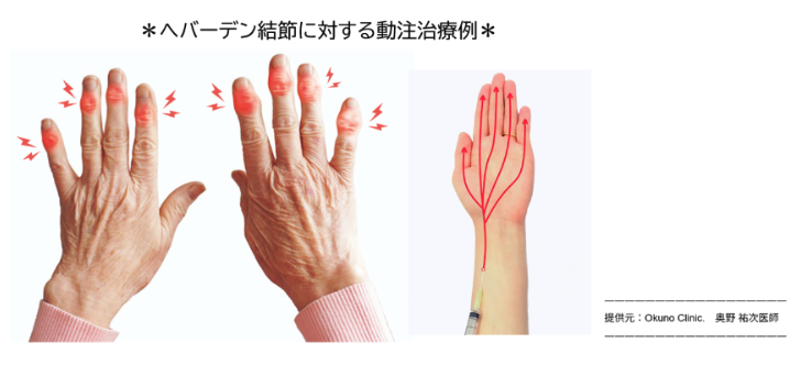 へバーデン結節に対する動注治療例の画像